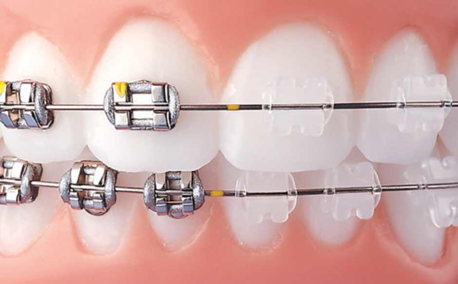 METAL VS CERAMIC ஏது BEST, Cost / Price of Braces in Chennai Madurai  Coimbatore