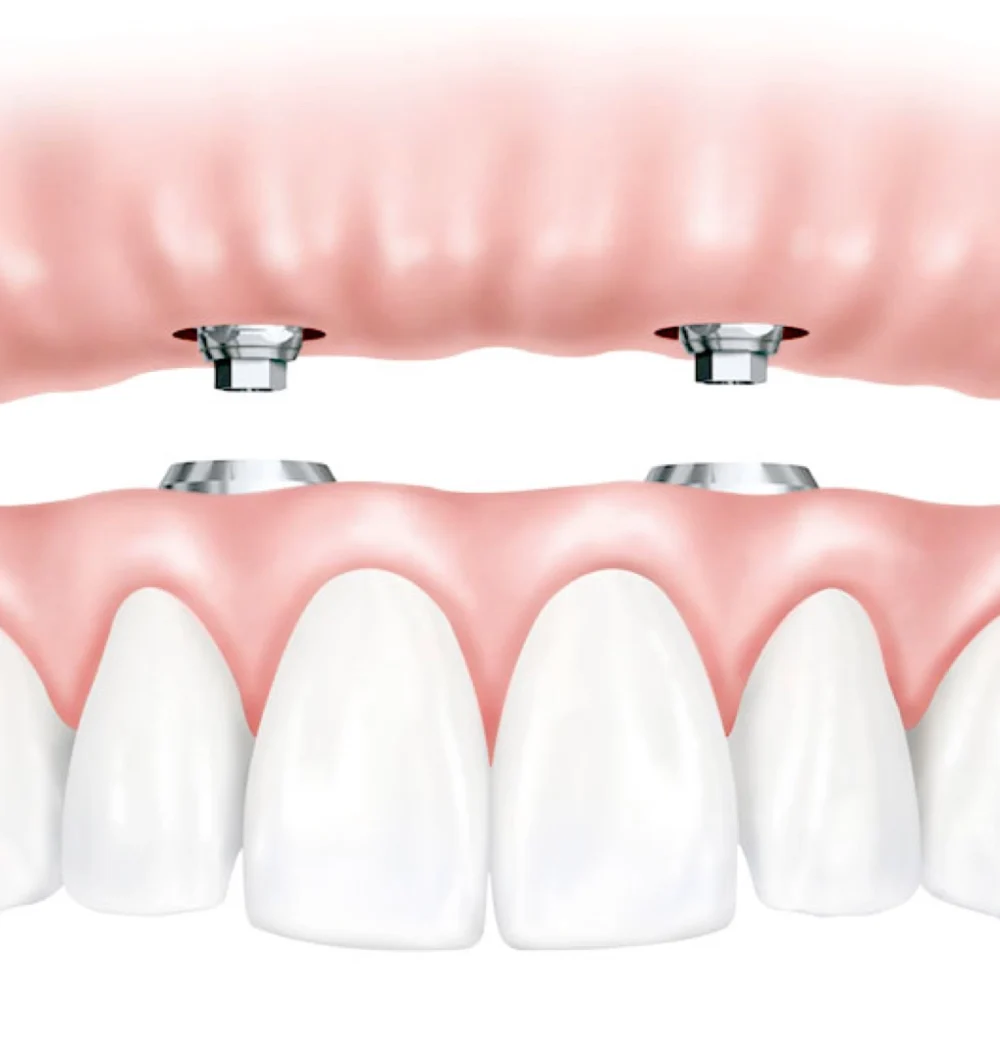 All on 4 Dental Implants Bangkok Thailand