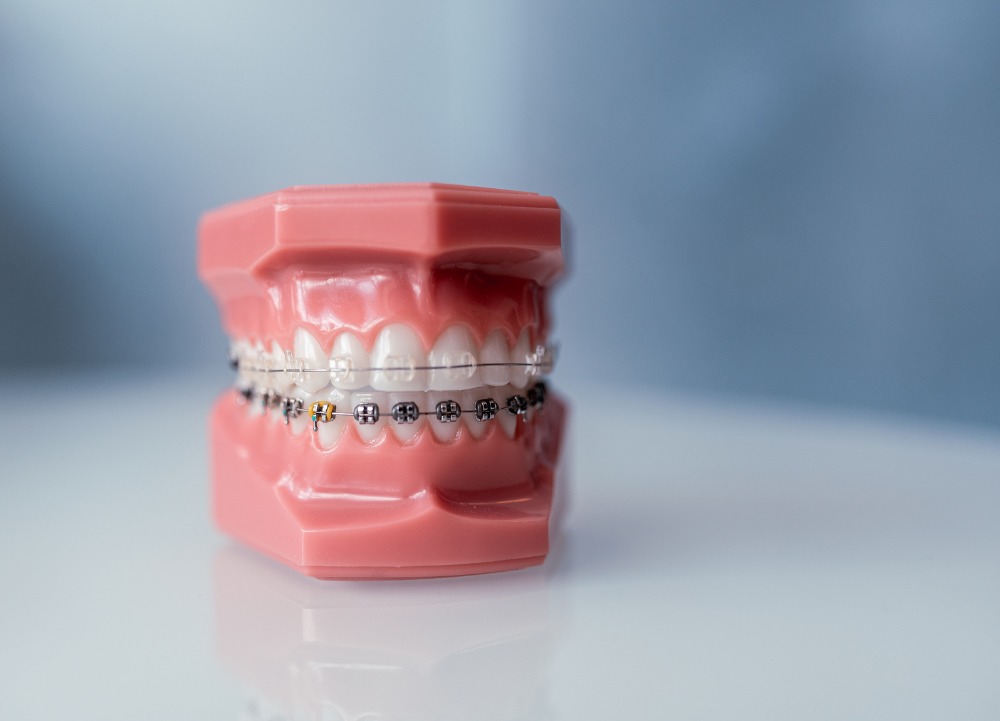 Orthodontic Braces and Invisalign Treatment Bangkok GDC