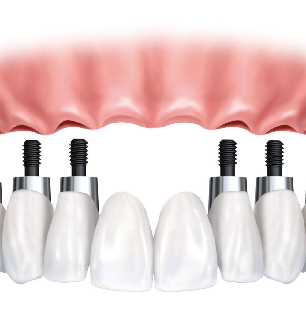 Full Mouth Dental Implants Bangkok Thailand