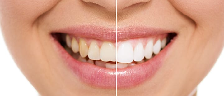 รอยยิ้มหลังทำฟันขาว (Teeth Whitening) ฟันขาวกระจ่างใสเป็นธรรมชาติ Professional Teeth Whitening Procedure Bangkok GDC