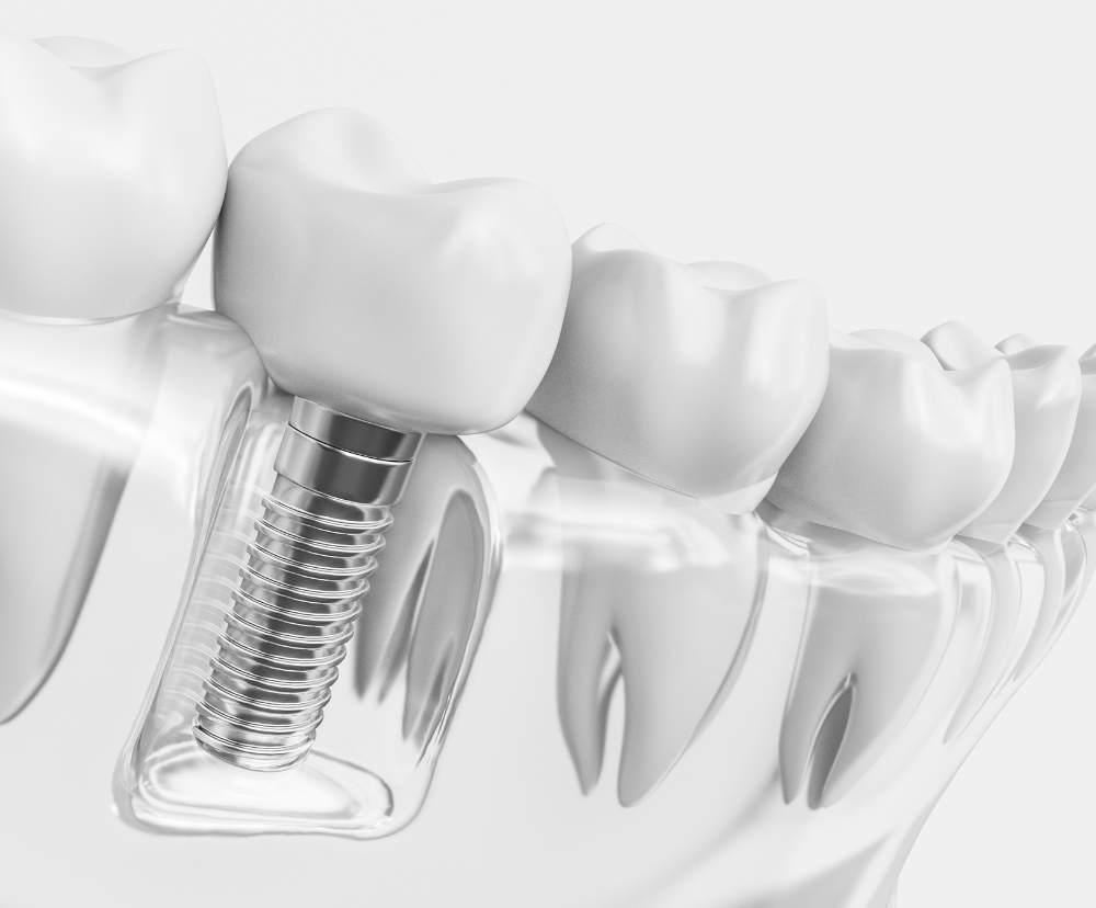Best Dental Implants Bangkok Thailand ห