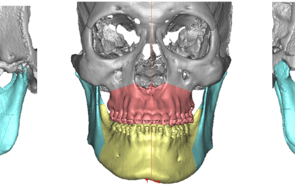 รีวิวจัดฟันผ่าตัดขากรรไกร ก่อนและหลัง Global Dental Complex