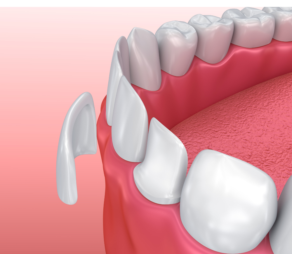 Porcelain Dental Veneers Bangkok Smile Transformation GDC