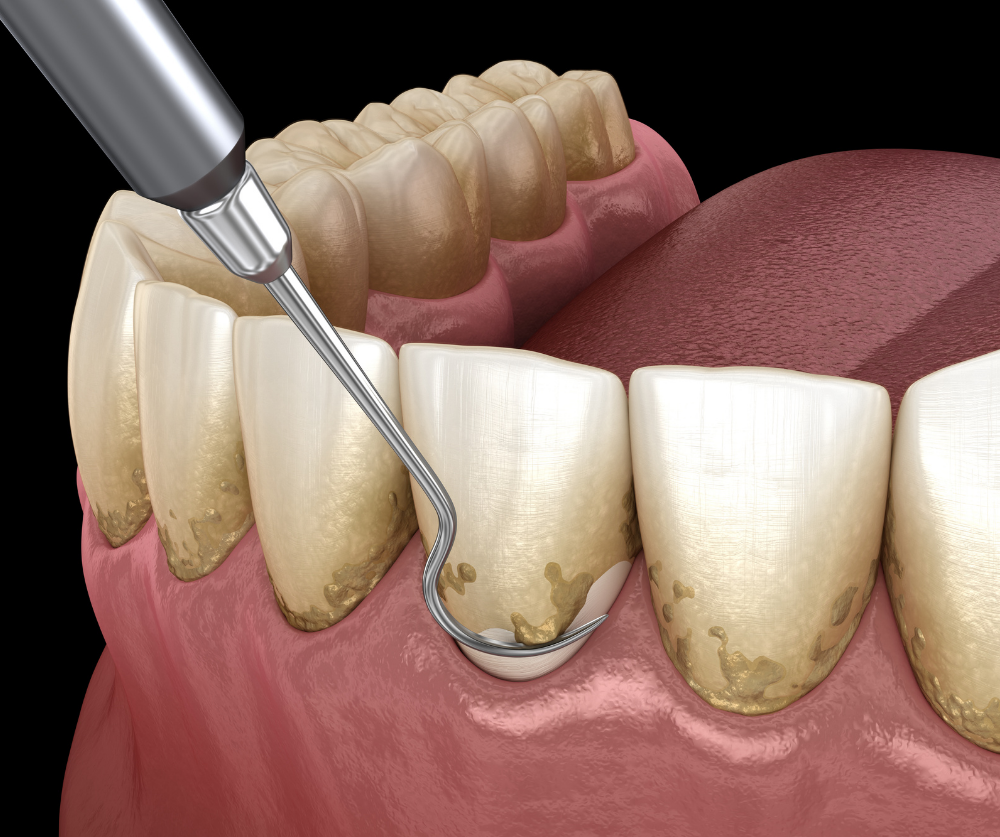 Professional gum treatment and periodontal scaling procedure Bangkok GDC