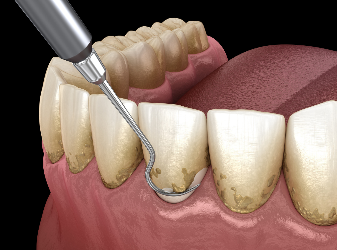 gum-treatment-best-bangkok-dental-clinic-best-dentist-in-bangkok