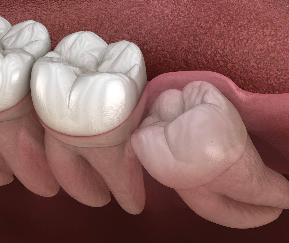 Gentle Wisdom Tooth Removal Procedure Bangkok