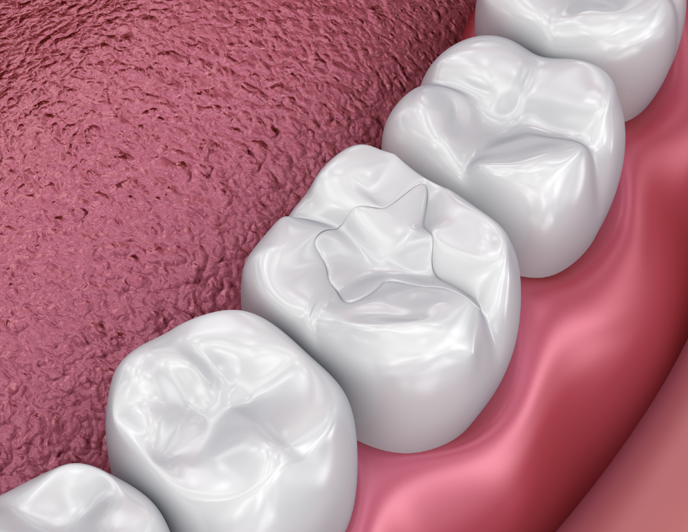 Safe metal-free tooth-colored dental filling Bangkok GDC