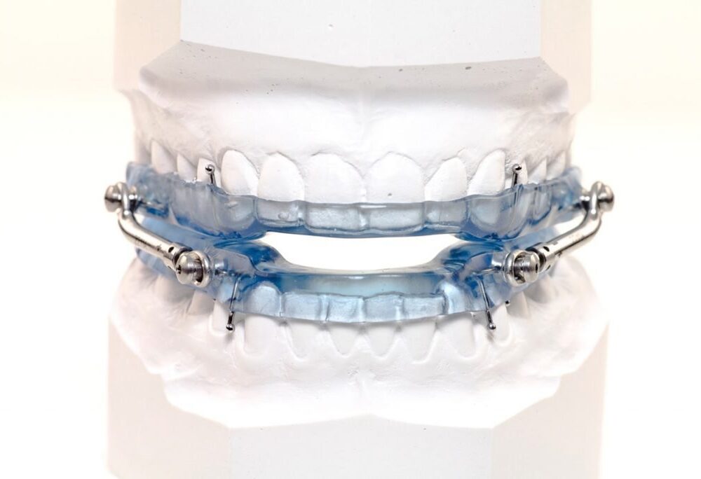 อุปกรณ์ในช่องปากรักษาภาวะหยุดหายใจขณะหลับ Sleep Apnea Treatment Oral Appliance Bangkok GDC