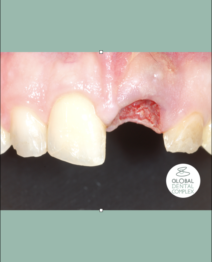 Anterior dental implant & Veneers Bangkok, Thailand