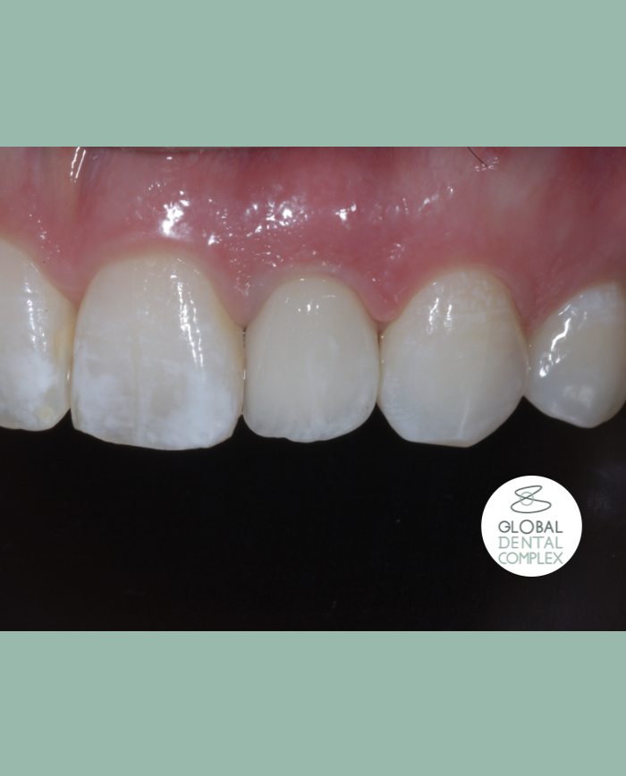 Single lateral incisor anterior implant