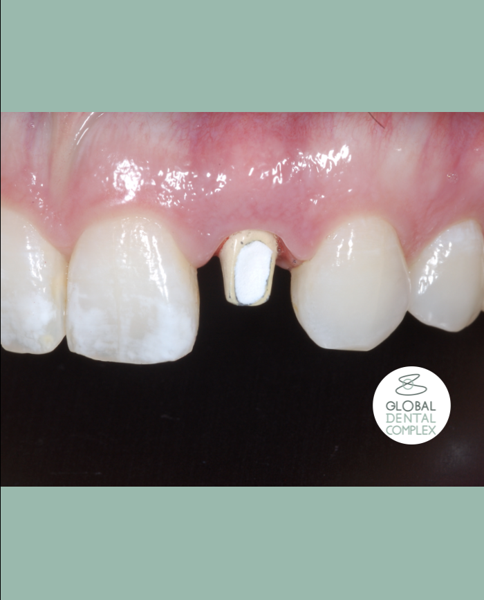 Single lateral incisor anterior implant