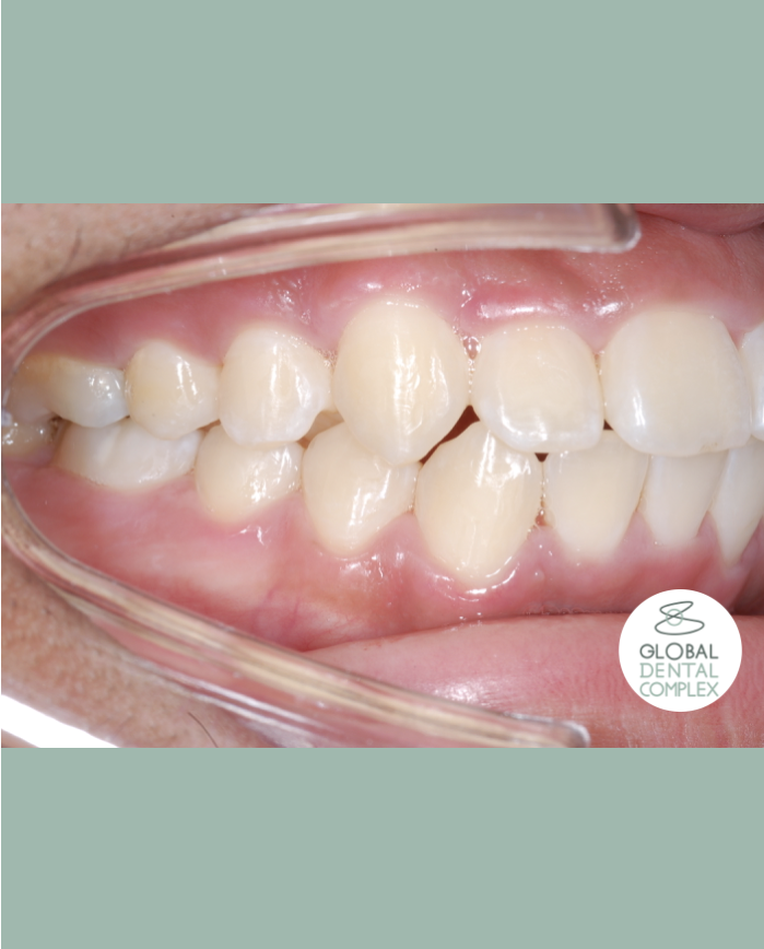 Crowding Correction without Tooth Extraction