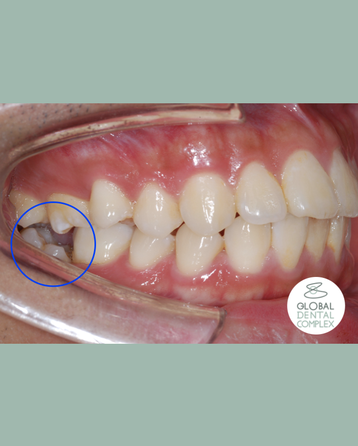 Uprighting Impacted Bilateral Lower Back Teeth (Molars)