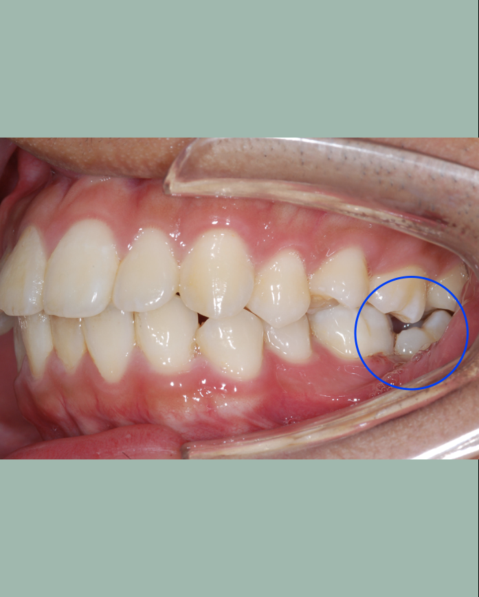 Uprighting Impacted Bilateral Lower Back Teeth (Molars)