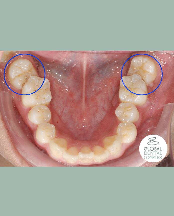 Uprighting Impacted Bilateral Lower Back Teeth (Molars)