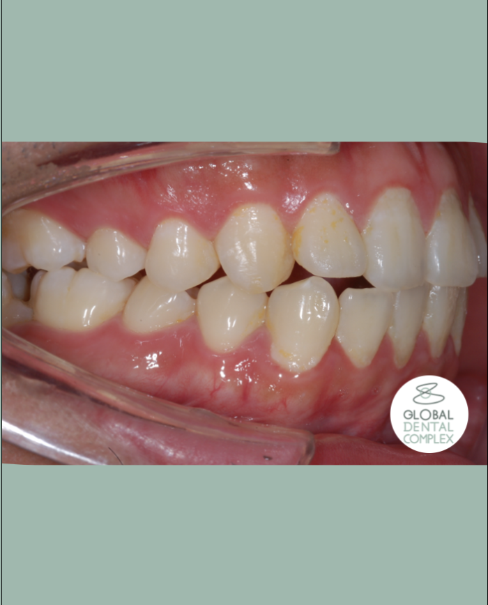 Uprighting Impacted Bilateral Lower Back Teeth (Molars) II