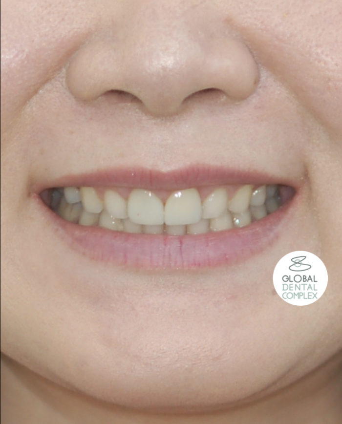 Veneers & Esthetic Gum Surgery Best Bangkok Dental Clinic Best