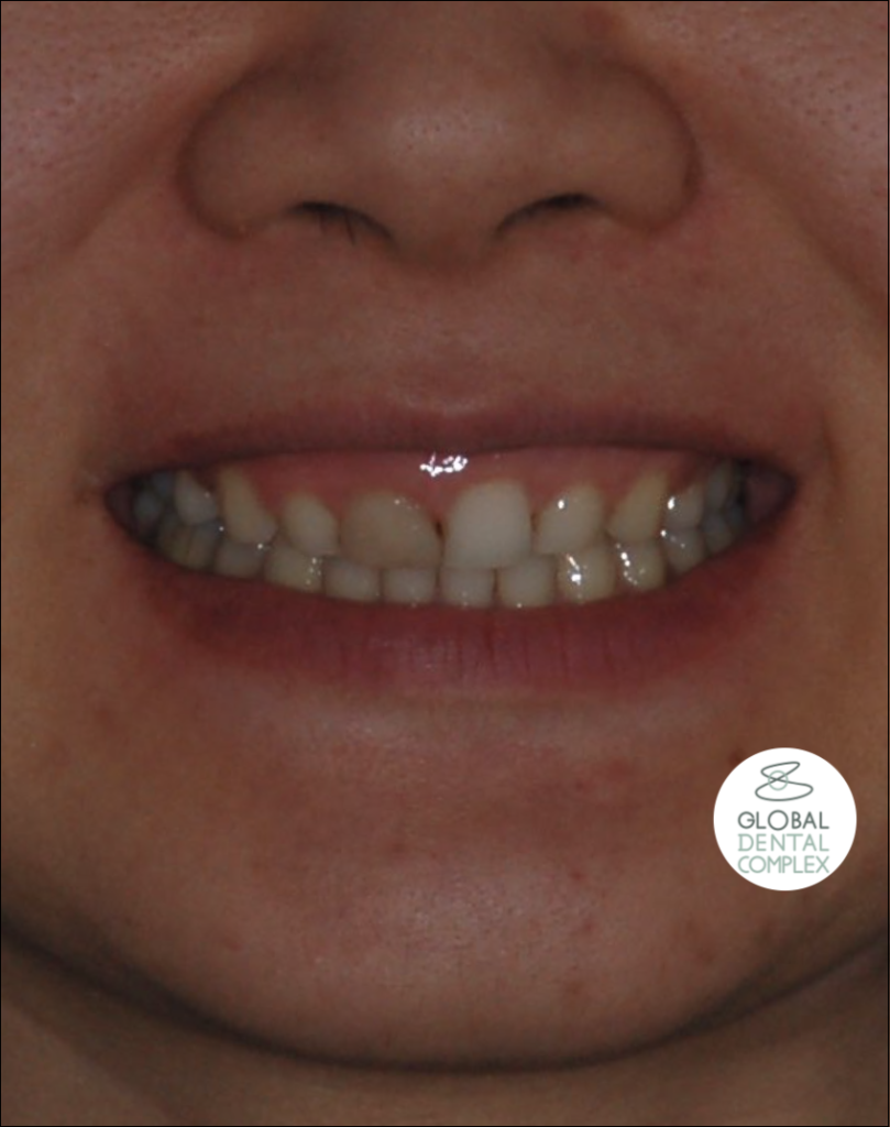 Veneers & Esthetic Gum Surgery Best Bangkok Dental Clinic Best