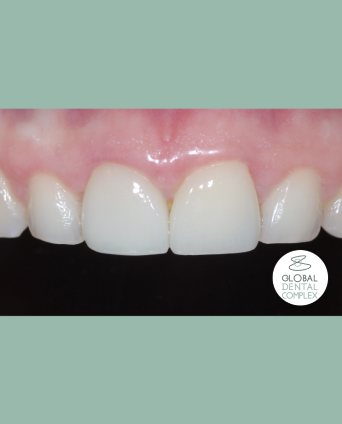 Veneers & Esthetic Gum Surgery Best Bangkok Dental Clinic Best