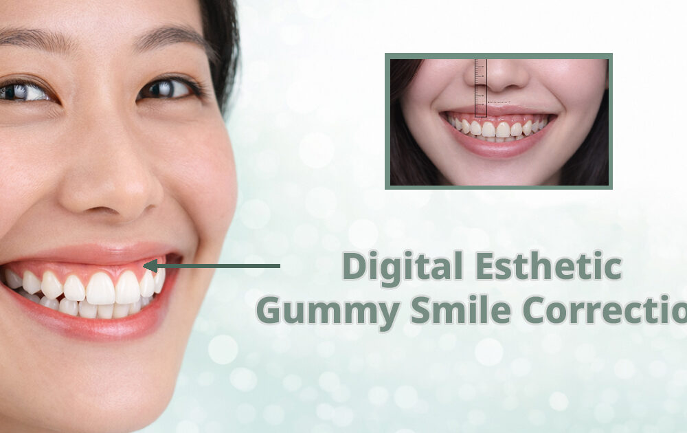 การออกแบบรอยยิ้มแก้ยิ้มเห็นเหงือกด้วยระบบคอมพิวเตอร์ Gummy Smile Correction Esthetic Gum Surgery Bangkok GDC