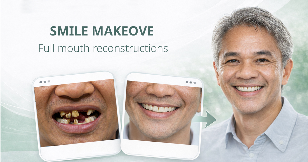 รอยยิ้มใหม่หลังการบูรณะฟันทั้งปาก (Full Mouth Rehabilitation) สวยสมบูรณ์ Full Mouth Reconstruction Smile Makeover Bangkok GDC