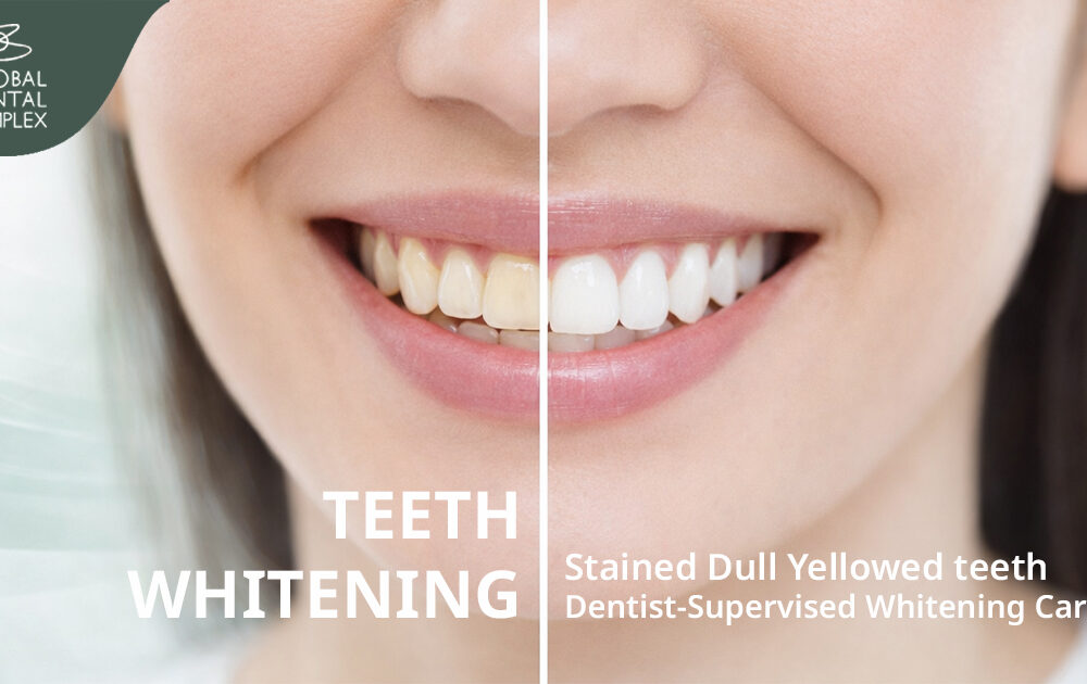 การเปรียบเทียบระดับสีฟันก่อนและหลังฟอกสีฟัน Professional Teeth Whitening Procedure Bangkok GDC