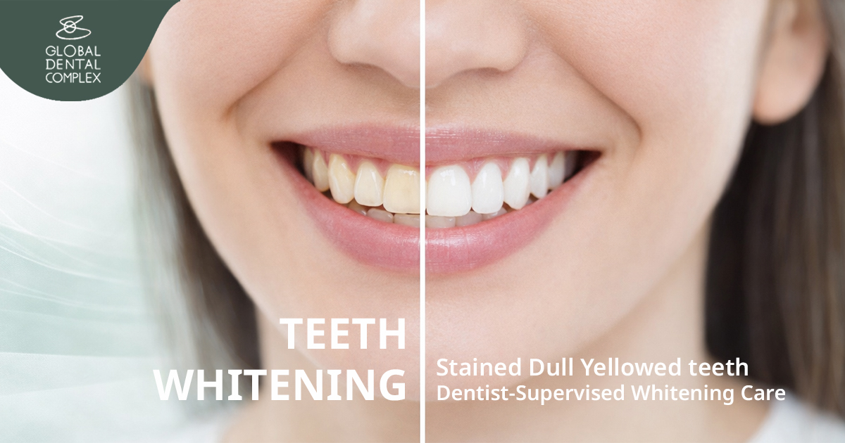 การเปรียบเทียบระดับสีฟันก่อนและหลังฟอกสีฟัน Professional Teeth Whitening Procedure Bangkok GDC