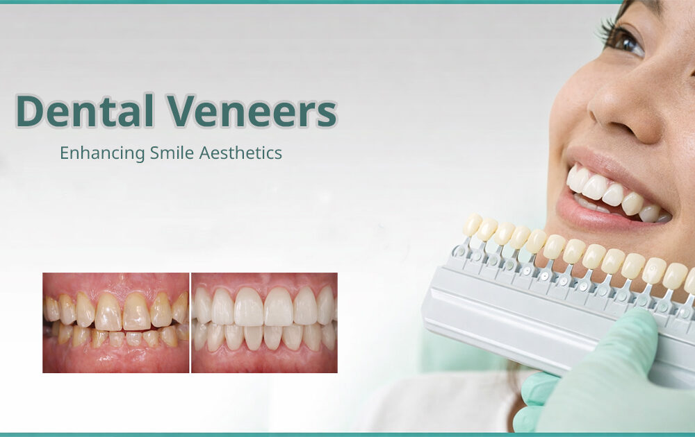 Porcelain Dental Veneers Bangkok Smile Transformation GDC