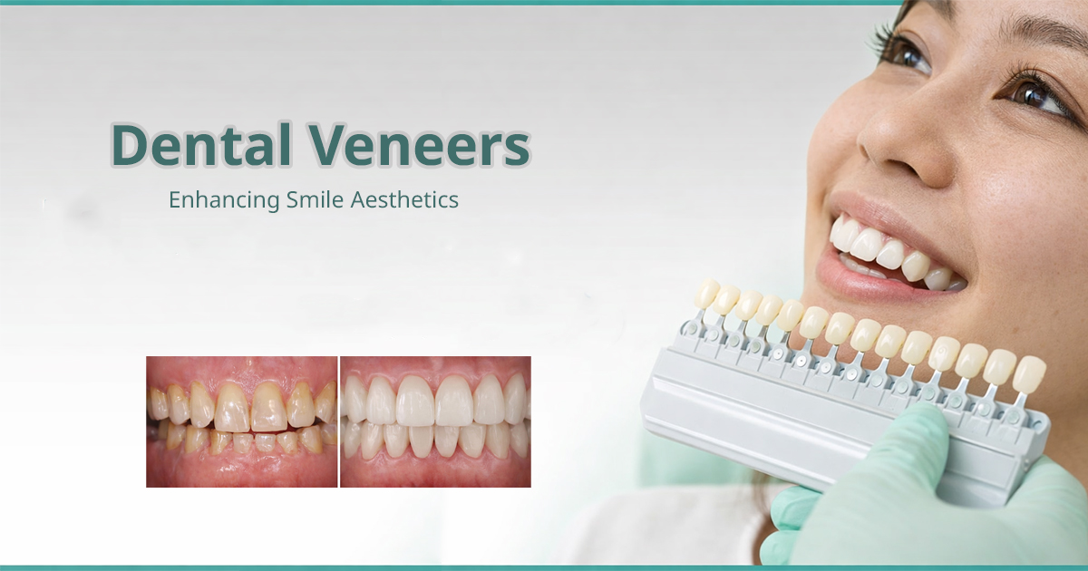 Porcelain Dental Veneers Bangkok Smile Transformation GDC