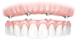 All-on-4 dental implant placement diagram รีวิวรากฟันเทียม All-on-4 ฟันใหม่ใน 1 วัน Global Dental Complex