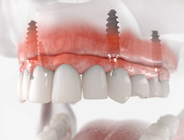 All-on-4 upper jaw dental implant model with titanium screws All on 4 ราคา 2026 พร้อมแผนการรักษาและตัวอย่างฟันติดแน่นทั้งปาก