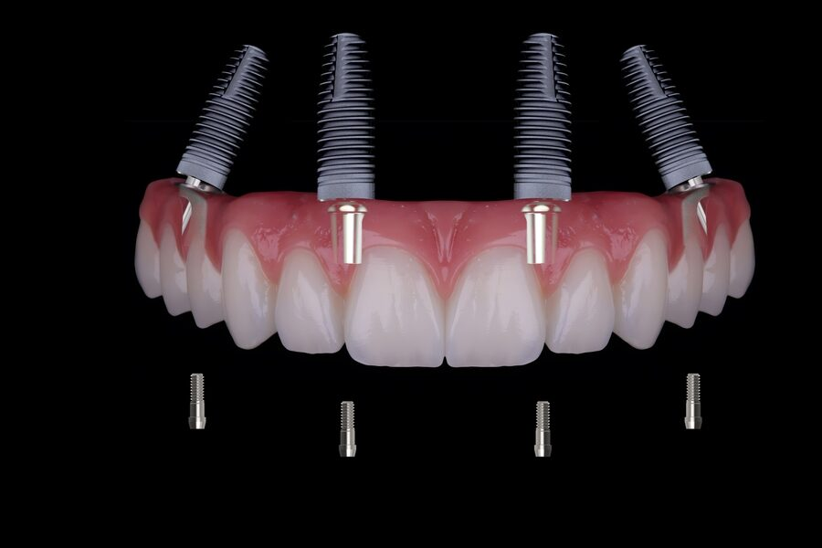 All-on-4 full arch dental implants on black background -- ฟันติดแน่นทั้งปากในวันเดียว All-on-4 Global Dental Complex