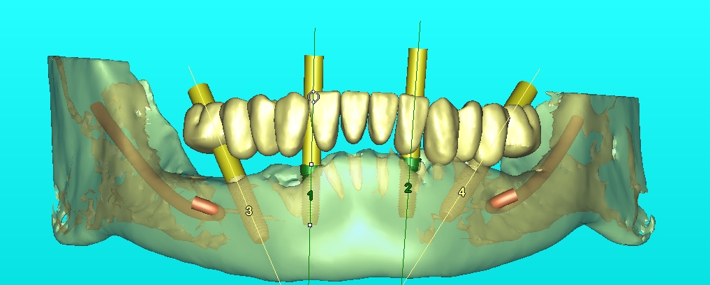 เทคโนโลยี Guided Surgery ทันตกรรม
