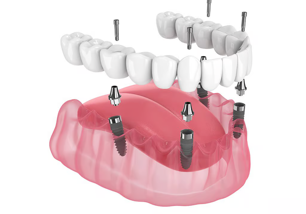 All-on-4 dental implant system exploded view model - รากฟันเทียมทั้งปาก ราคา พร้อมข้อมูล All-on-4 และการดูแลหลังรักษา