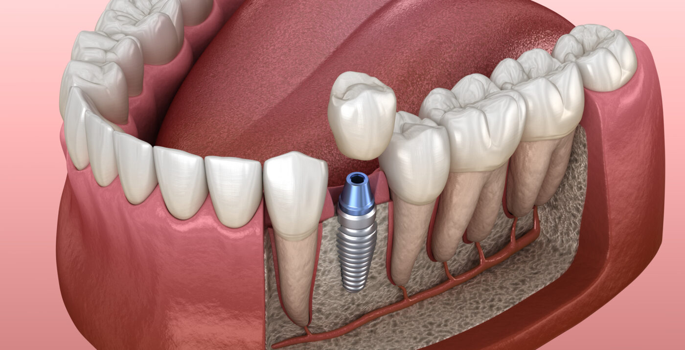 Dental implant placed in jawbone 3D illustration - รากฟันเทียมคืออะไร ข้อดี ข้อเสีย ราคา และขั้นตอนการรักษาแบบครบถ้วน