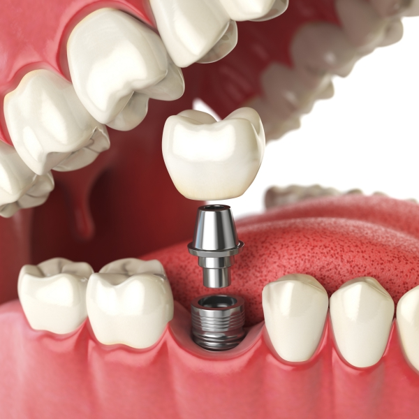 Dental implant versus dental bridge comparison diagram - เปรียบเทียบรากฟันเทียม vs สะพานฟัน ข้อดีข้อเสียและราคา