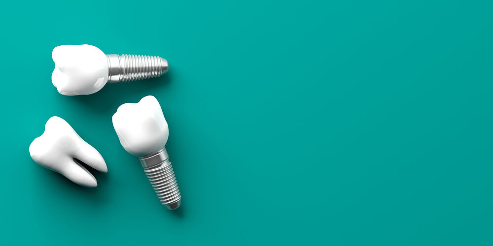 Dental implant pricing chart 2026 - รากฟันเทียม ราคา 2026 พร้อมตารางเปรียบเทียบแบรนด์และแพ็กเกจคุ้มค่า