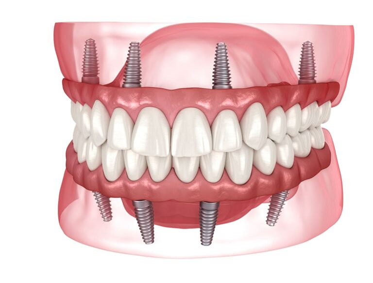 All-on-4 dental implant procedure model showing implant placement - All-on-4 คืออะไร วิธีทำฟันติดแน่นทั้งปากบนรากเทียม 4 ตัว