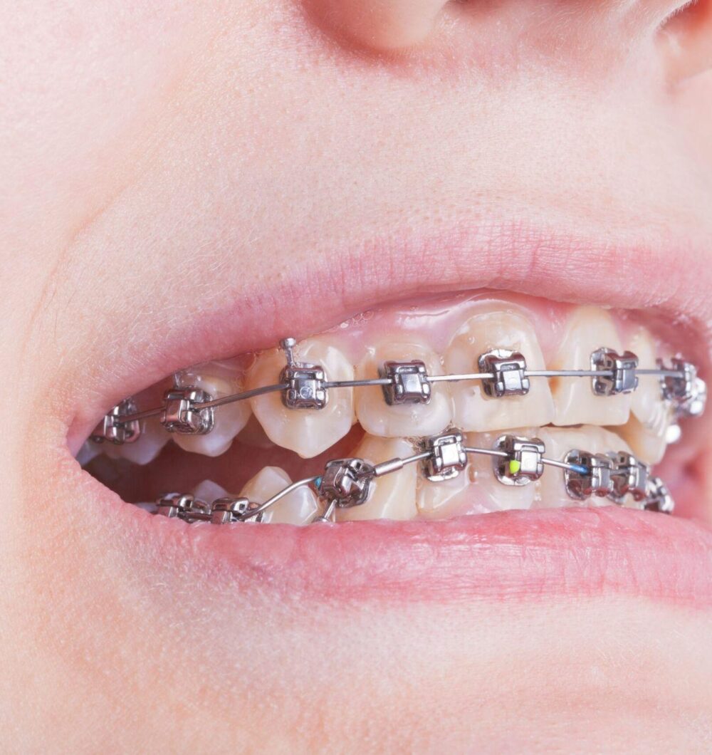 จัดฟันแก้ฟันเหยิน ฟันยื่น ก่อนและหลัง GDC Bangkok Celebrities and clear aligners: why Invisalign is the top choice for professional smiles and red carpet events at GDC.