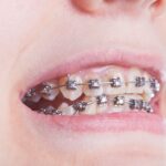 จัดฟันแก้ฟันเหยิน ฟันยื่น ก่อนและหลัง GDC Bangkok Celebrities and clear aligners: why Invisalign is the top choice for professional smiles and red carpet events at GDC.