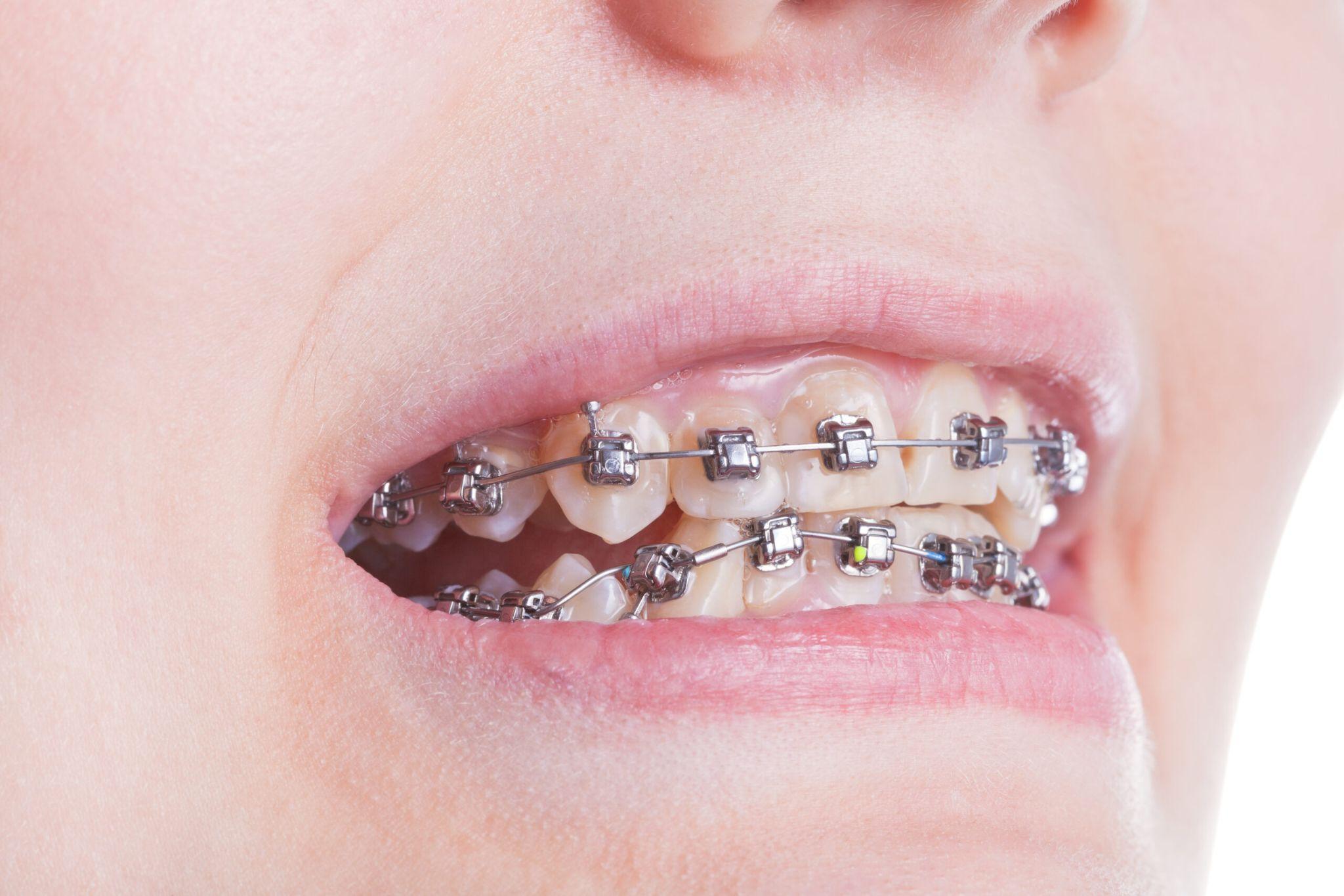 orthodontic treatment for protruding teeth - Celebrities and clear aligners: why Invisalign is the top choice for professional smiles and red carpet events at GDC.