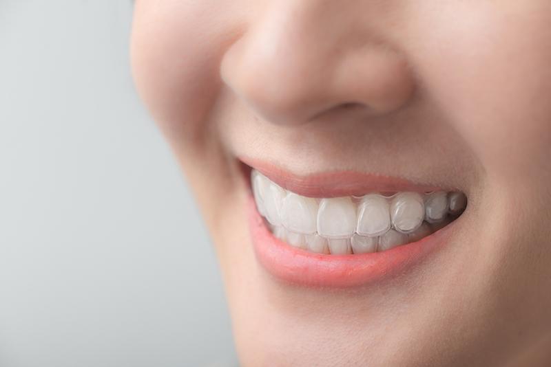 Braces reviews and patient testimonials for metal, Damon, and Invisalign treatments at Global Dental Complex.