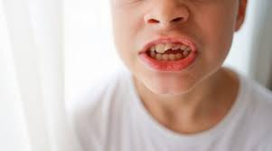 ราคาจัดฟันใส Invisalign กรุงเทพ คลินิกทันตกรรมมาตรฐาน GDC