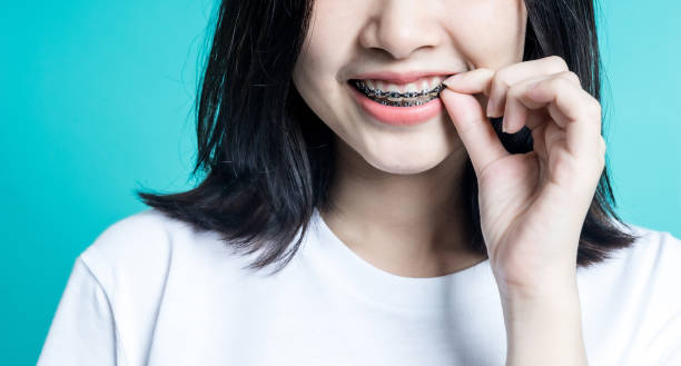 รีวิวจัดฟัน Global Dental Complex เคสก่อนและหลังการรักษา